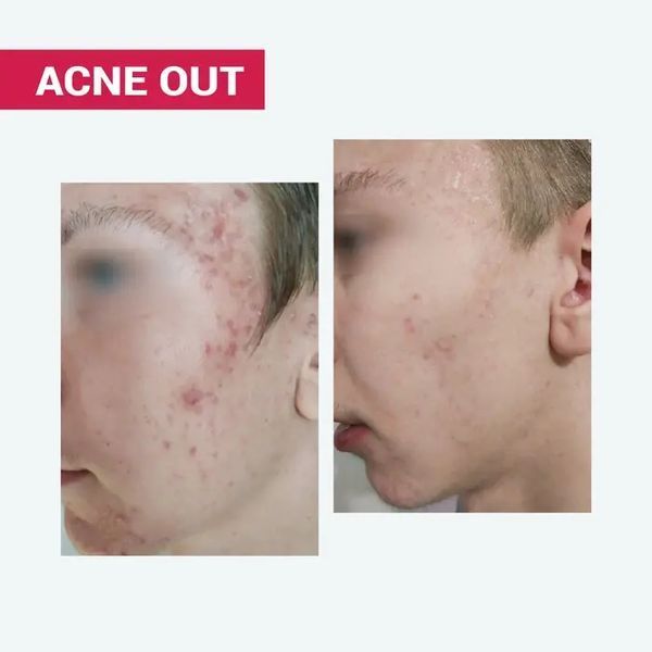 АКТИВНИЙ КРЕМ ACNE OUT / ДЛЯ ПРОБЛЕМНОЇ ШКІРИ З ВУГРАМИ ТА КОМЕДОНАМИ / ЛОКАЛЬНОГО НАНЕСЕННЯ 30 мл biotr_579366 фото