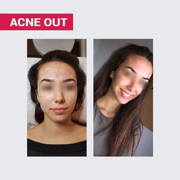 АКТИВНИЙ КРЕМ ACNE OUT / ДЛЯ ПРОБЛЕМНОЇ ШКІРИ З ВУГРАМИ ТА КОМЕДОНАМИ / ЛОКАЛЬНОГО НАНЕСЕННЯ 30 мл biotr_579366 фото