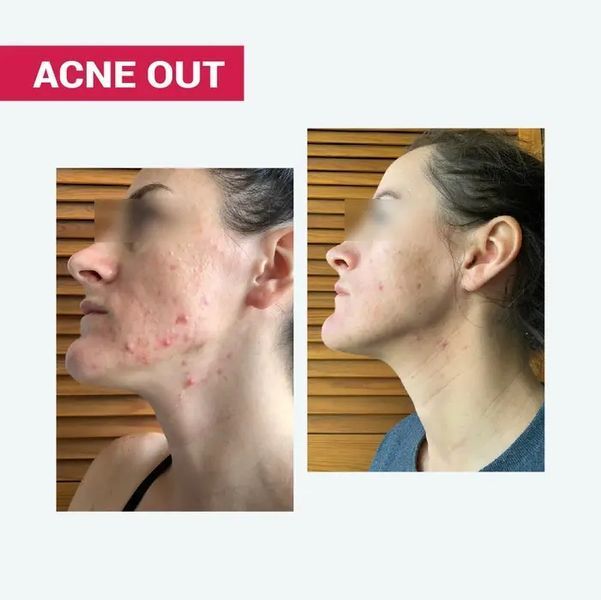 АКТИВНИЙ КРЕМ ACNE OUT / ДЛЯ ПРОБЛЕМНОЇ ШКІРИ З ВУГРАМИ ТА КОМЕДОНАМИ / ЛОКАЛЬНОГО НАНЕСЕННЯ 30 мл biotr_579366 фото
