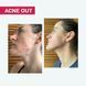 АКТИВНИЙ КРЕМ ACNE OUT / ДЛЯ ПРОБЛЕМНОЇ ШКІРИ З ВУГРАМИ ТА КОМЕДОНАМИ / ЛОКАЛЬНОГО НАНЕСЕННЯ 30 мл biotr_579366 фото 3