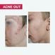 АКТИВНИЙ КРЕМ ACNE OUT / ДЛЯ ПРОБЛЕМНОЇ ШКІРИ З ВУГРАМИ ТА КОМЕДОНАМИ / ЛОКАЛЬНОГО НАНЕСЕННЯ 30 мл biotr_579366 фото 4