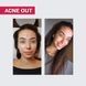АКТИВНИЙ КРЕМ ACNE OUT / ДЛЯ ПРОБЛЕМНОЇ ШКІРИ З ВУГРАМИ ТА КОМЕДОНАМИ / ЛОКАЛЬНОГО НАНЕСЕННЯ 30 мл biotr_579366 фото 2