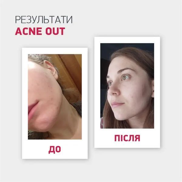 Матуючий тонік ACNE OUT / Для жирної шкіри та при легких формах акне 60 мл  biotr_982996 фото