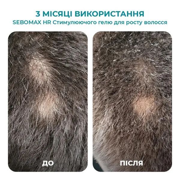СТИМУЛЮЮЧИЙ ГЕЛЬ ДЛЯ РОСТУ ВОЛОССЯ SEBOMAX HR, 26 МЛ biotr_536268 фото